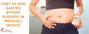 Typical costs can run from $20,000 to $25,000, according to the national institute of diabetes and digestive and kidney diseases. Mini Gastric Bypass Surgery In Mexico Mexicali 2021