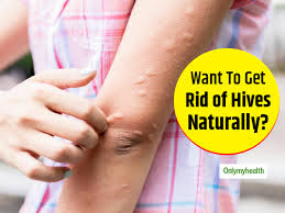 irritated with hives try these