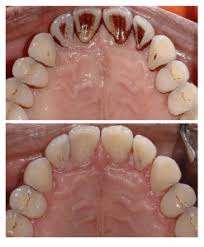 gum periodontal disease treatment in