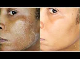 Don't forget to like and comment letting us know how you. Natural Chemical Peel At Home Remove Acne Wrinkles Dark Spots Blemishes Khichi Beauty Youtube Chemical Peel Chemical Peel At Home Natural Aging Skin Care