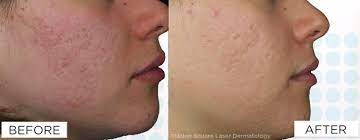 laser skin resurfacing treatment guide