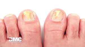 what is toenail fungus you