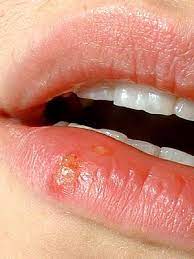 cold sores fever blister treatment
