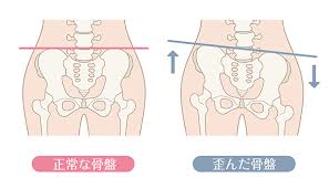 骨盤矯正って1回でも効果はあるの? - 名古屋の鍼灸接骨院・ハートメディカルグループ