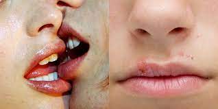 infections you can get from kissing