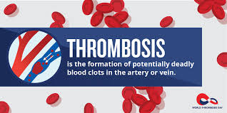 This clot may block or impede blood circulation in the affected area. Dia Mundial De La Trombosis Trombosis