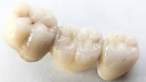 dental bridge 4 types benefits use