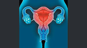 Principales factores de riesgo y síntomas. Paliar Los Sintomas De La Endometriosis Mediante La Dieta