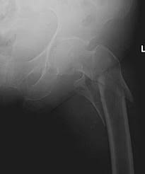 subtrochanteric fractures trauma