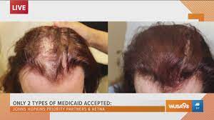 hair loss treatment at skin oasis
