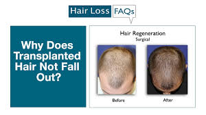 why does transplanted hair not fall out