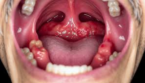 roof of mouth hurts