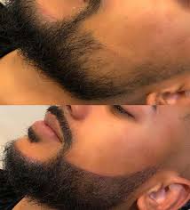 beard microblading