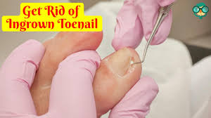 get rid of an ingrown toenail overnight