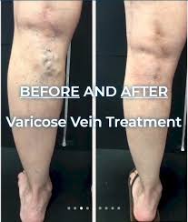 Are varicose vein treatments covered by medicare? Before And After Varicose Vein Treatment Vein Specialists Of The Carolinas