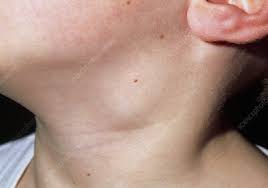 swollen lymph node in the neck of boy