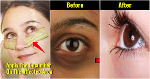 how to reduce dark circles indian