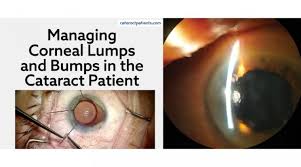 Cataract Surgery In Complex Corneas