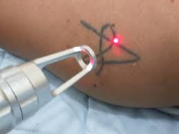 laser tattoo removal in siliguri find