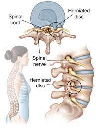 what is a herniated disc can