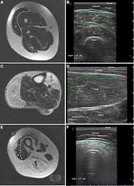 Mri of the soft tissues of the foot visualizes the fat cushions of the sole, heels, fingers and can show swelling, foci of infiltration and inflammation. Quantitative Muscle Mri And Ultrasound For Facioscapulohumeral Muscular Dystrophy Complementary Imaging Biomarkers Springerlink