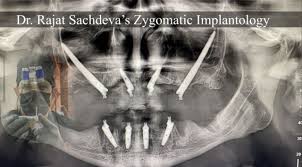cost of full mouth dental implants in