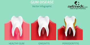gingivitis vs periodonis symptoms