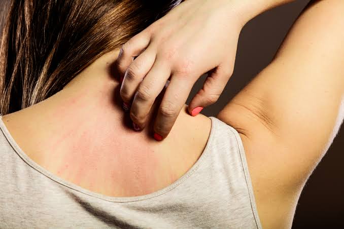 Itchy Skin | Causes & Treatment - Vermont Urgent Care