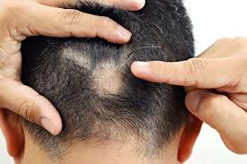 alopecia aerata treatment it s causes