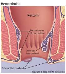In most cases they can become strangulated and cause extreme pain. Hemorrhoids Internal External Pictures Symptoms Causes Treatment