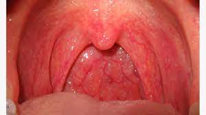 rash and swollen lymph nodes causes