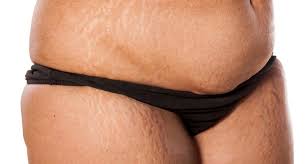 stretch marks for african americans
