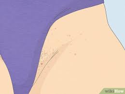 how to get rid of fordyce spots 12