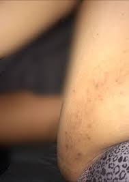 dark patches scars on inner thigh is