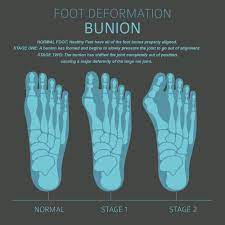 best shoes for bunions
