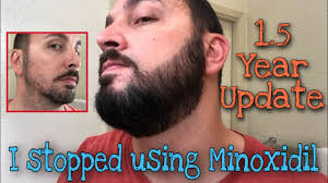 i stopped using minoxidil on my beard