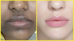 how to remove pigmentation around mouth