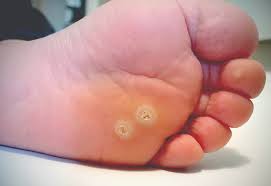 Removal of foot plantar wart part 2. Current And Emerging Concepts In Wart Treatment Podiatry Today