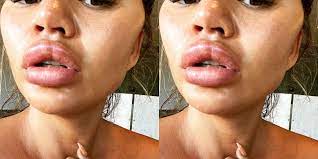 chrissy teigen s lips swelled up after