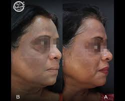 laser pigmentation treatment in delhi