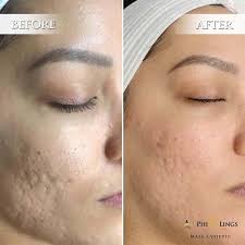 microneedling effects risks cost