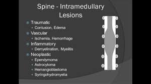 localization of spinal mes