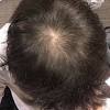 The severity of hair loss can vary from a small area to the entire body. 1