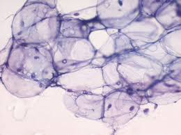 lipoma cytological findings springerlink