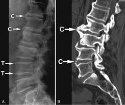 vertebral osteophytosis spondylosis