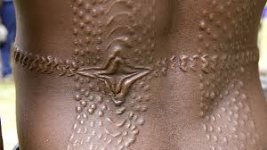 keloid tattoo when scars form