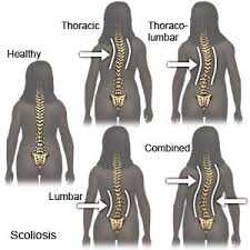 scoliosis in children what you need