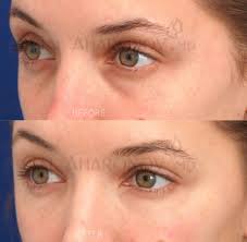 6.3 how do you get rid of under eye wrinkles? Under Eye Fillers For Dark Circles Bags And Hollowness Under Eye Fillers Lip Fillers Undereye