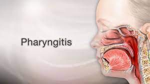 pharyngitis sore throat information