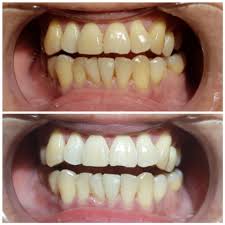 teeth whitening sparklesmile teeth